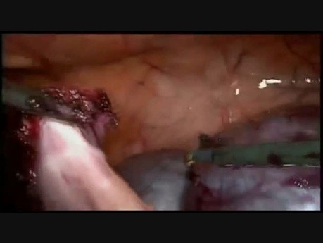 Minilaparoscopic Surgery for Wwo Large Pelvic Cysts