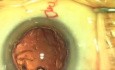 Fugo Plasma Capsulotomy: Stripping Cortex Peripherally .Small Capsulotomy Rim Surgery