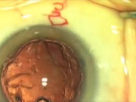 Fugo Plasma Capsulotomy: Stripping Cortex Peripherally .Small Capsulotomy Rim Surgery