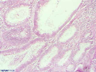 Rectal Adenocarcinoma that infiltrates the second and the 
 third valve (4 of 5)