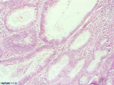 Rectal Adenocarcinoma that infiltrates the second and the 
 third valve (4 of 5)