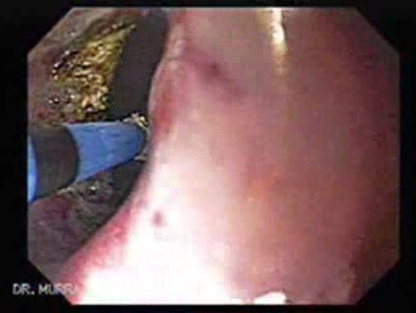 Gastric Cicatrization With Pylous Stenosis (13 of 23)