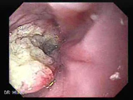 Esophageal Squamous Cell Carcinoma - Endoscopic Presentation of the Tumor