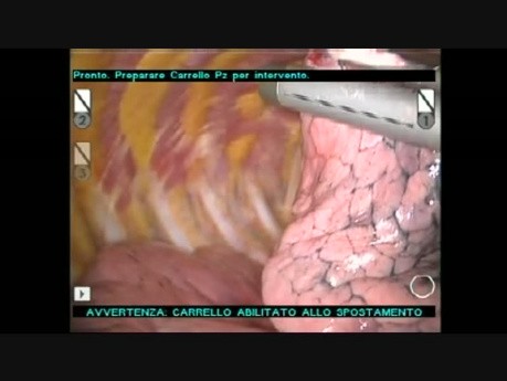 Radio Guided Occul Lesion Localisation