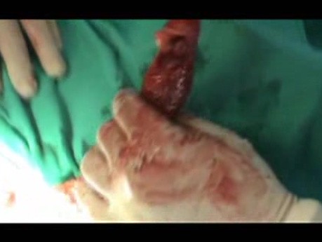 Barrett Adenocarcinoma - Therapeutic Endoscopy (5 of 7)