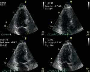 Dobutamine Induced Systolic Anterior Motion (SAM)