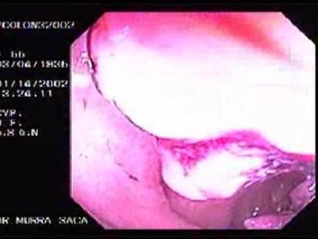 Rectal Endoscopy - Adenocarcinoma (1 of 3)