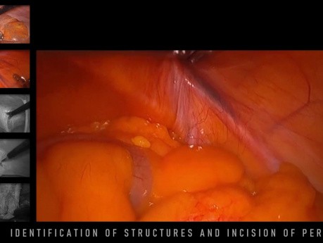 Transabdominal Preperitoneal Hernia Repair (TAPP)