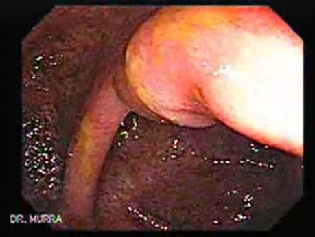 Massive Rectal Bleeding (5 of 11)