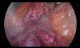 Replaced Hepatic Artery from SMA (Type 5) During Laparoscopic Pancreatoduodenectomy
