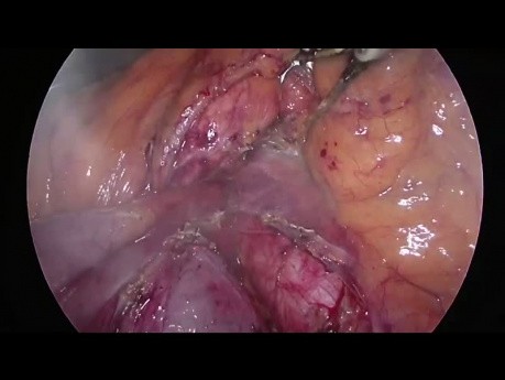 Replaced Hepatic Artery from SMA (Type 5) During Laparoscopic Pancreatoduodenectomy