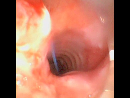 Broncoflex Percutaneous Dilatational Tracheostomy