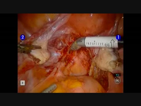 Endometriosis Excision