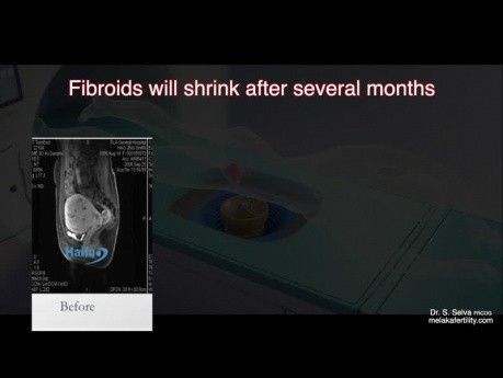HIFU for Fibroid