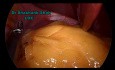 3 Ports Laparoscopic Sleeve Gastrectomy