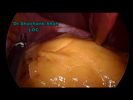3 Ports Laparoscopic Sleeve Gastrectomy