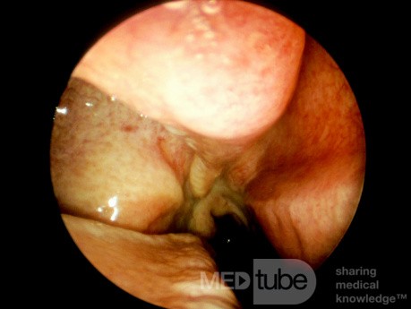 Maxillary Sinus Hypoplasia [type]