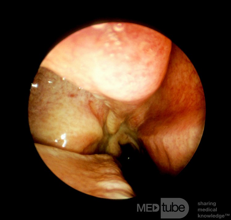 Maxillary Sinus Hypoplasia [type]