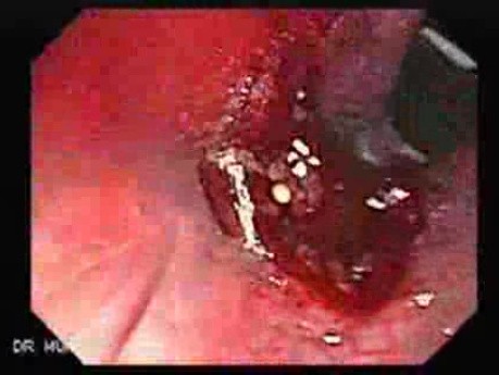 Endoscopic Resection of Giant Tubulo-Villous of the rectum (7 of 35)