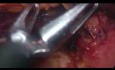 Laparoscopic Distal Pancreatectomy for Large SPN - Full Length Procedure