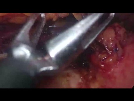 Laparoscopic Distal Pancreatectomy for Large SPN - Full Length Procedure