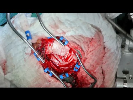  Injury with a Saw