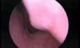 Adenoids - Endoscopic View