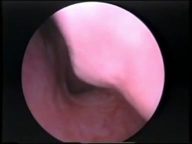 Adenoids - Endoscopic View