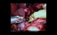 Robotic Release of Median Arcuate Ligament Syndrome