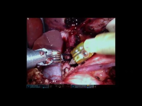 Robotic Release of Median Arcuate Ligament Syndrome