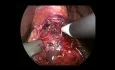 Laparoscopic Heller Myotomy and DOR Fundoplication for Recurrent Achalasia