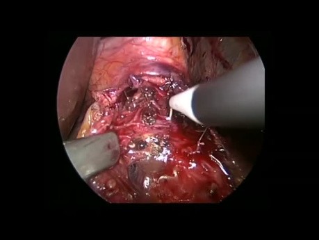 Laparoscopic Heller Myotomy and DOR Fundoplication for Recurrent Achalasia
