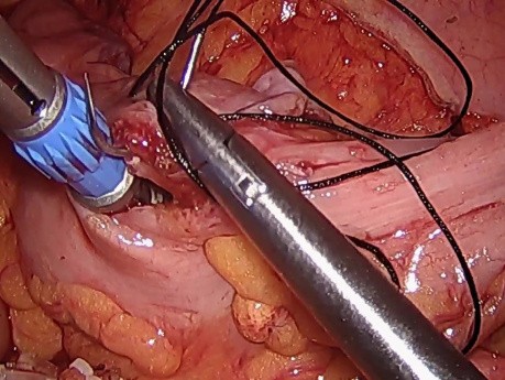 Nose Sigmoidectomy