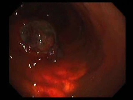Gastrointestinal Stromal Tumor - GIST (13 of 65)