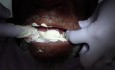 Removable Denture Clasp Repair Part 2 - Alginate Pickup Impression