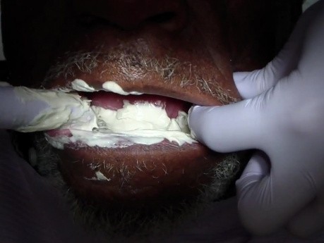 Removable Denture Clasp Repair Part 2 - Alginate Pickup Impression