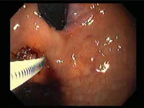 Gastric Varices - Endoscopic Ablation With Cyanoacrylate Glue (8 of 18)