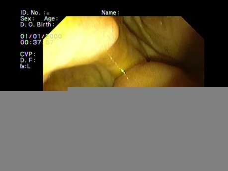 ERCP Plastic Stent Malposition