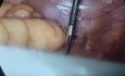 Low laparoscopic anterior resection