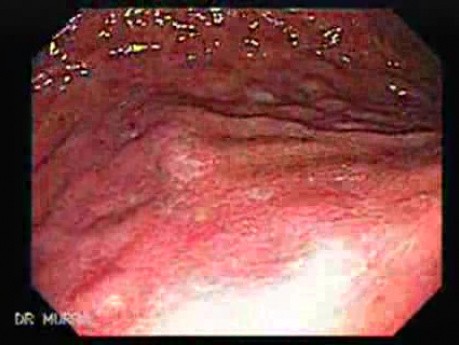 Systemic Lupus Erythematosus - Stomach finding (5 of 7)