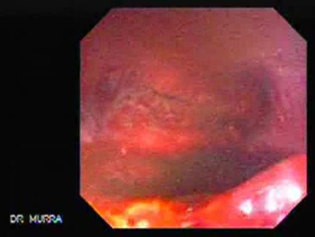 Upper Gastrointestinal Bleeding - Posthemorrhagic Appearance