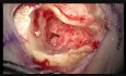 Right Cochlear Implantation