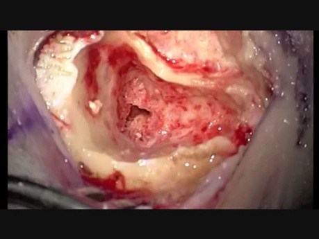 Right Cochlear Implantation