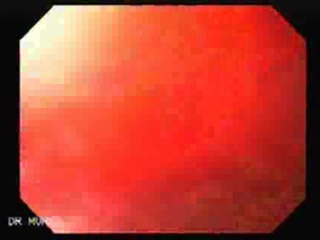 Recurrent Gastric Adenocarcinoma - Endoscopy (3 of 4)