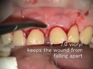 Estethic Crown Elongation