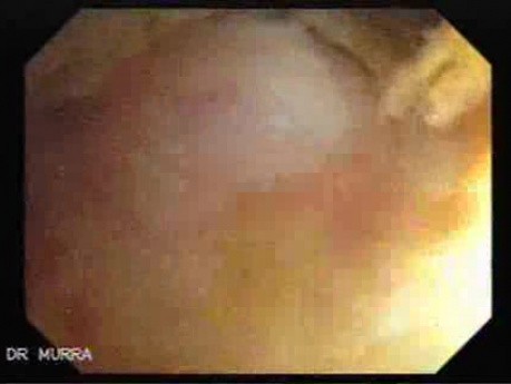 Non - Hodgkin's Lymphoma Of The Colon (2 of 16)