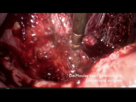 Difficult Vascular Access During Challenging Polymyomectomy