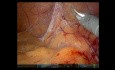 Robotic Total Mesorectal Excision for Rectal Cancer - Full-length Video