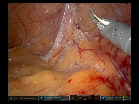 Robotic Total Mesorectal Excision for Rectal Cancer - Full-length Video