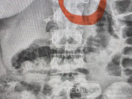 Renal Cyst Aspiration